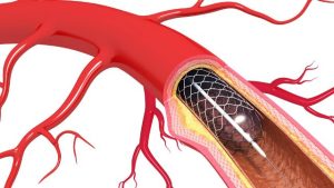 What is Coronary Angioplasty Procedure – Is It Safe?