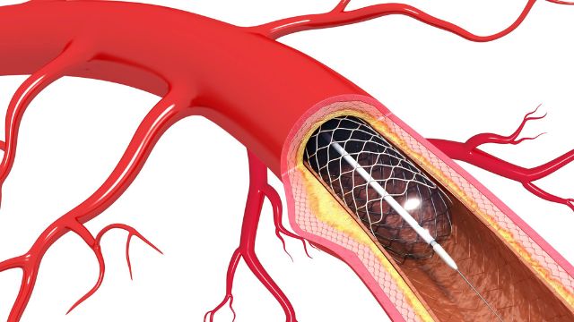 Coronary Angioplasty