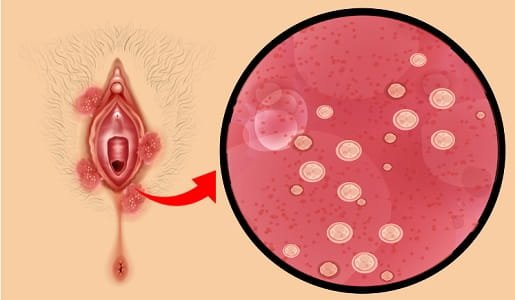 Understanding Phimosis Complications: What You Should Know